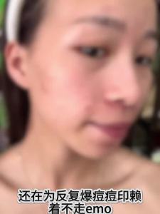 FANGXIANG | Gel Làm Mờ Sẹo Mụn