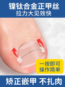 Nail Groove Brace: A Handy Gadget for Ingrown Nail Inflammation