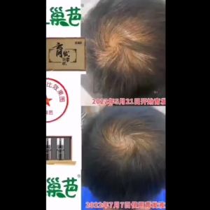 [ Hair Loss and Hair Loss ]💗🙋‍♀️💗[93% Positive Rate ] ZhiNaoBa Anti-Hair Loss Hair Growth Serum for Preventing Hair Loss and Thickening