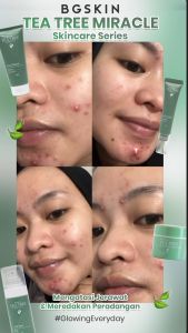 BG Skin ~ Paket Acne Tea Tree