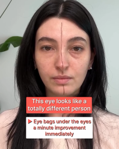 [Dr.Melaxin Official] Eyephalt Eyebag Cream 10ml (Bio-Spicule + EGF) : Instant Lifting & Tightening for Saggy Eye Bags