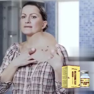 South Moon Mole Removal Cream Skin Tag And Mole Removal Krim Penghilang Tahi Lalat dan Skin Tag