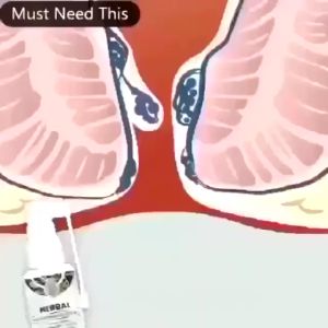 Hemorrhoids Spray Natural Herbal Hemorrhoid Spray Internal External Hemorrhoids Removal Cream Stop Bleeding Reduce Pain Relieve Swelling Fissure Bloody Stool inflammation Treatmen