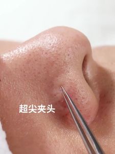 NILIYA | Professional Grade Blackhead & Pimple Tweezers for Beauty Salon