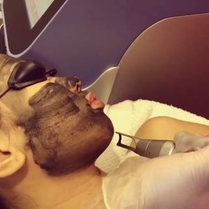 Than hoạt tính bắn laser trẻ hóa da GEL CARBON trẻ hóa 80ml
