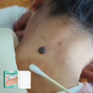 Wart Removal Patches - Skin Growth Removal Patches - Eliminate facial acne and growths soothe and repair skin absorb secretions breathe and fight infection.