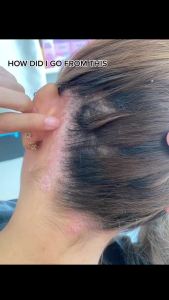 Syampoo kelemumur shampoo psoriasis anti dandruff shampoo rambut gugur dan kelemumur Antifungal ubat kelemumur kepala itchy scalp oil control Deep clean removes mites 頭皮屑 洗發水去屑止痒洗发水