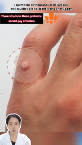 [SG In Stock]Japan Warts Removal Skin Tags Painless Mole Corn Genital Warts Remover