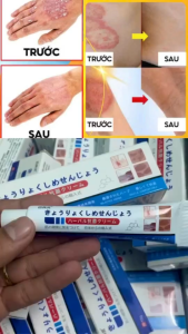 Combo (6 TUÝT) Kem vàng Japan Nấm da đầu nấm móng tay chân.