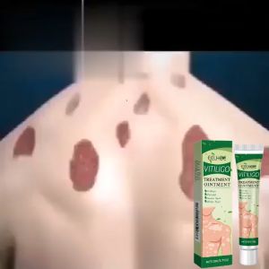 EELHOE Krim perbaikan kulit bercak putih Perbaikan kulit dermatofit pada tangan dan kaki Krim perawatan luar