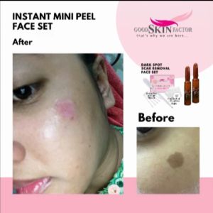Mini Set of GSF TCA 10% Instant Peeling for Dark Spot Scar Removal (Acne scar/ PIH/PIE Body Scar