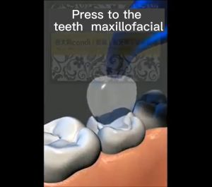 Dental Aesthetics Printing Kit Restorative Filling Materials Composite Tools Dental Materials