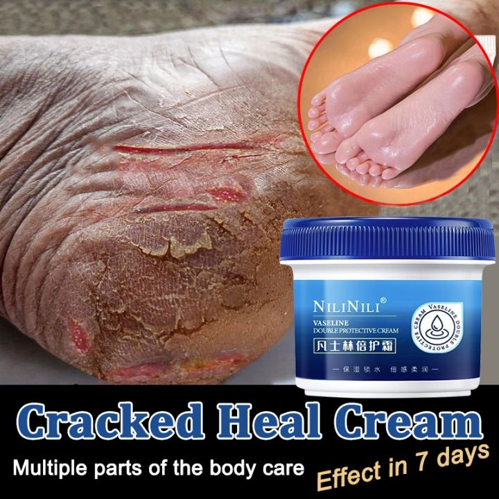 Dry Hands Cause Of Extremely Dry Feet Vaseline Foot Treatment For