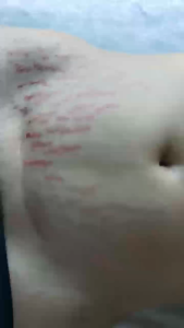 ✨ข้อเสนอจำกัดเวลา✨Dr. Jungle ครีมลดรอยแตกลาย บำรุงผิว ยกกระชับ ฟื้นฟูและให้ความชุ่มชื้น เหมาะสำหรับครีมทาท้องลาย ครีมลบรอยแตกลาย ครีมซ่อมแซมรอยแตก ครีมทาต้นขาลาย ยาทารอยแตกลาย และครีมฟื้นฟูผิวต่างๆ ค่ะ 50ml