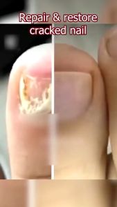 Nail Repair Cream 15g repair nail fungus cream onychomycosis nail repair treatment cream nail soothing repair Cream