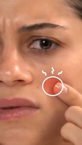 COD Acne Pimple Patch Sticker 36Pcs Transparan Polos Untuk Harian Menutup Jerawat