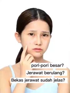 krim jerawat dan bekas jerawat 20g Krim anti jerawa-cream jerawat ampuh bpom Cream Jerawat Cream Acne krim jerawat paling ampuh
