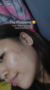 VERDEFY Scar Cream 10g for Acne Marks Pimple Marks Darkspot Stretchmarks