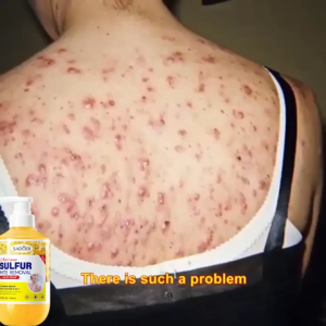 100% ของแท้ เจลอาบน้ำ ครีมอาบน้ำกำจัดไร กำจัดไรฝุ่น สิว ยับยั้งไร เจลอาบน้ำกำจัดไร คุมน้ำมันสดชื่น ผิวเนียนนุ่มสัมผัสสบาย 500ML ไรฝุ่น