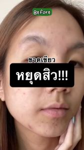 สูตรลดปัญหาสิว Merci VITAMIN C+ ANTI-ACNE 15 ml
