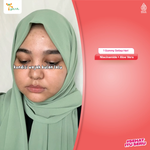 [Clearance Sale] Niacinamide Gummy untuk Anti Jerawat | Youvit AcNO 90 Hari dengan Vitamin A (Alternatif Retinol)
