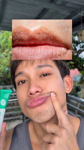 [Payday 25.9] Abera Fordyce Cream 20g - Lips Balm For Ances & Fordyce Spots Removal Softening Lips