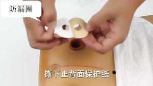 5/10 cái túi hậu môn nhân tạo vòng chống rò rỉ thuốc mỡ lỗ thoát vòng lỗ thoát chăm sóc bảo vệ da lỗ thoát vòng đáy đĩa