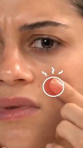 Acne Patch Bening Transparan Stiker Jerawat Tahan Air Hologram Sakura Butterfly Kupu Kupu Star Love