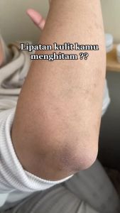 Cream Pencerah Kulit Lipatan Ketiak Siku Leher Ekstra Niacinamide