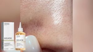 EELHOE Glycolic Acid 7%Toning Solution Acne And Pimple Dark Spot Marks Remover Exfoliating Exfoliates Blackheads peel Cleans Pores Shrink pores 100ml