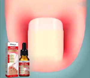 Anti Paronychia Relief Oil Ingrown Toenail Anti Fungal Toe Nail Ingrown Corrector Removal Paronychia Toenailcare Easy To Use Nail Treatment Solution Nail Fungal Repair Paronychia & Fungal Nail Repair