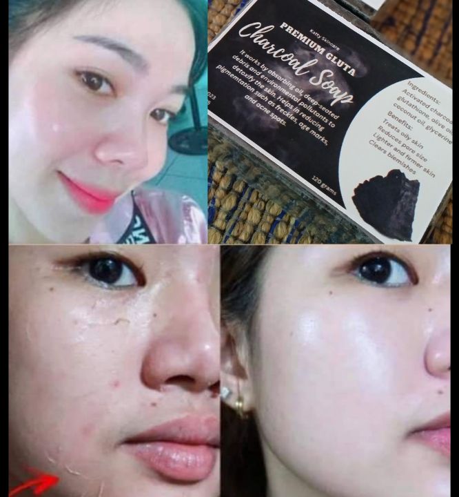 CHARCOAL BLEACHING SOAP REMOVE ACNE,DARK SPOTS 120g Lazada PH