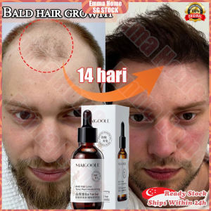 🚀SG stock🚀 Hair growth serum for men women / Hair fall treatment / Hair loss tonic / Anti hair loss serum / Ginger hair tonic / 白黑客防脱发精华