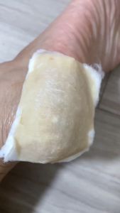 Tumitku Obat Kaki Kapalan Dan Pecah Tumitku 30ml Mengatasi Kulit Kaki Pecah Kering Kapalan Kutu Air