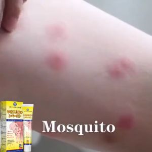 Anti-itch Cream Antibacterial Cream: Eczema Cream Used to Treat Dermatitis, Eczema, Psoriasis, Eczema Itching, Allergies, and Psoriasis