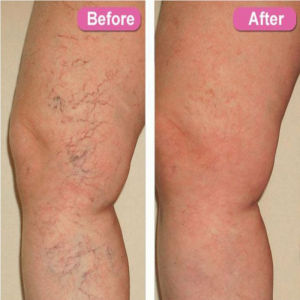 Varicose Veins Cream Relieve Vasculitis Phlebitis Spider Pain Relief Ointment Herb Plaster Body skin care 20g Earthworm leg