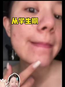 RUYI | Salicylic Acid Acne Removal Essence Oil Control Skin Restoration Pore Minimizer