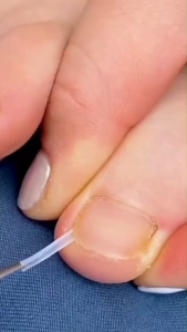 อุปกรณ์แก้ไขเล็บขบ เล็บคุด แก้ไขเล็บงุ้ม 10 ชิ้น/ขวด เล็บม้วนแทงเนื้อ รูปตัว C ตัดได้ตามต้องการ เล็บอุปกรณ์เล็บขบ ร้านไทย ส่งจาก กทม. Dedeegood