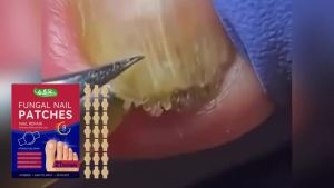 Miếng Dán Chống Nấm Móng Tay Để Điều Trị Bệnh Nấm Móng Giảm Móng Tay Bị Đổi Màu Mờ Đục Miếng Dán Sửa Chữa Loại Bỏ Viêm Chăm Sóc Móng Tay Dễ Gãy