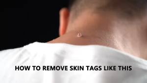 2 In1 Painless Auto Skin Tag Mole Wart Removal Kit Cleaning Tools Face Skin Care Body Wart Dot Treatments Remover Beauty Health