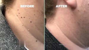 Eye Removal Wart Gel Warts cream eye warts essence ointment 20g Warts Skin Tag cream to hard skin wart Corn Warts calluses foot Corns Meat Thorn Antibacterial