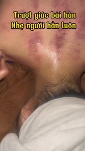 Dụng Cụ Chày Đồng Inox Giải Cơ Diện Chẩn