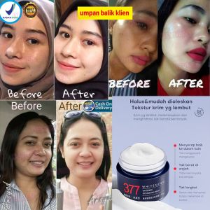 377 Whitening Blemish Flek Penghilang Flek Hitam Ori Anti Freckle Salep Melasma Dark Spot Pemutih Noda Hitam Magic Glow Cream 50g