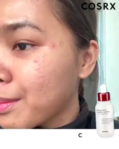 COSRX AC Collection Blemish Spot Clearing Serum 40ml | 85% Propolis & 4% Niacinamide | Calms Breakouts & Fades Dark Spots for Acne-Prone Skin