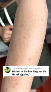 Kem Đồi Mồi Tay Và Mặt Mờ Đồi Mồi Phục Hồi Da Chống Lão Hoá Dr.Li (20g)