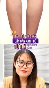 Miếng Dán Cải Thiện Suy Giãn Tĩnh Mạch SOUTH MOON - Ngưng Tình Trạng Suy Giảm Tĩnh Mạch Hiệu Quả Làm Bền Thành Mạch Giảm Sưng Phù Nề Tăng Cường Lưu Thông Máu Tăng Độ Dẻo Dai Của Thành Mạch Thoải Mái Ngủ Ngon Sâu Giấc 12 Miếng Nhập Khẩu Mỹ | Moska