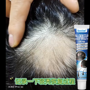 Sumifun 斑秃膏 Alopecia Hair Growth Cream 20g Fast Hair Growth Oil Baldness Cream