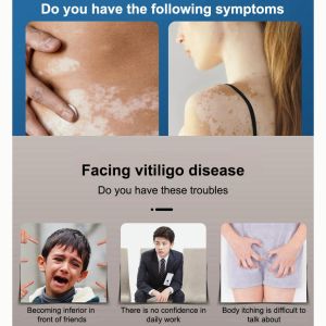 🔥🔥Kem điều trị bạch biến 20g chăm sóc da loại bỏ đốm trắng đốm bạch biến mồ hôi kích hoạt melanin