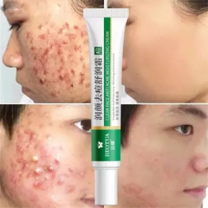 Cara Efektif Menghilangkan Jerawat Dengan Krim Pemutih Wajah & Pembersih Wajah Anti-Acne