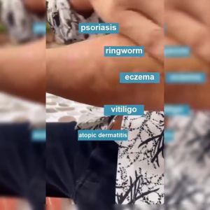 Skin Herbal Psoriasis Dermatitis Eczema Pruritus Psoriasis Cream Ointment 7g doctor Zu 5show